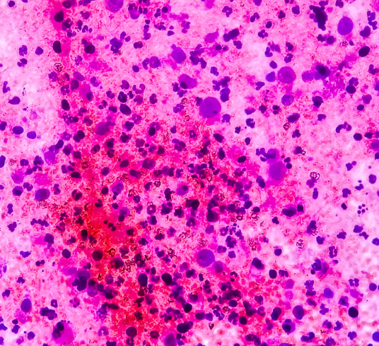 Enhanced image of a bladder cell as if under a microscope to indicate better detection of non-muscle-invasive bladder cancer