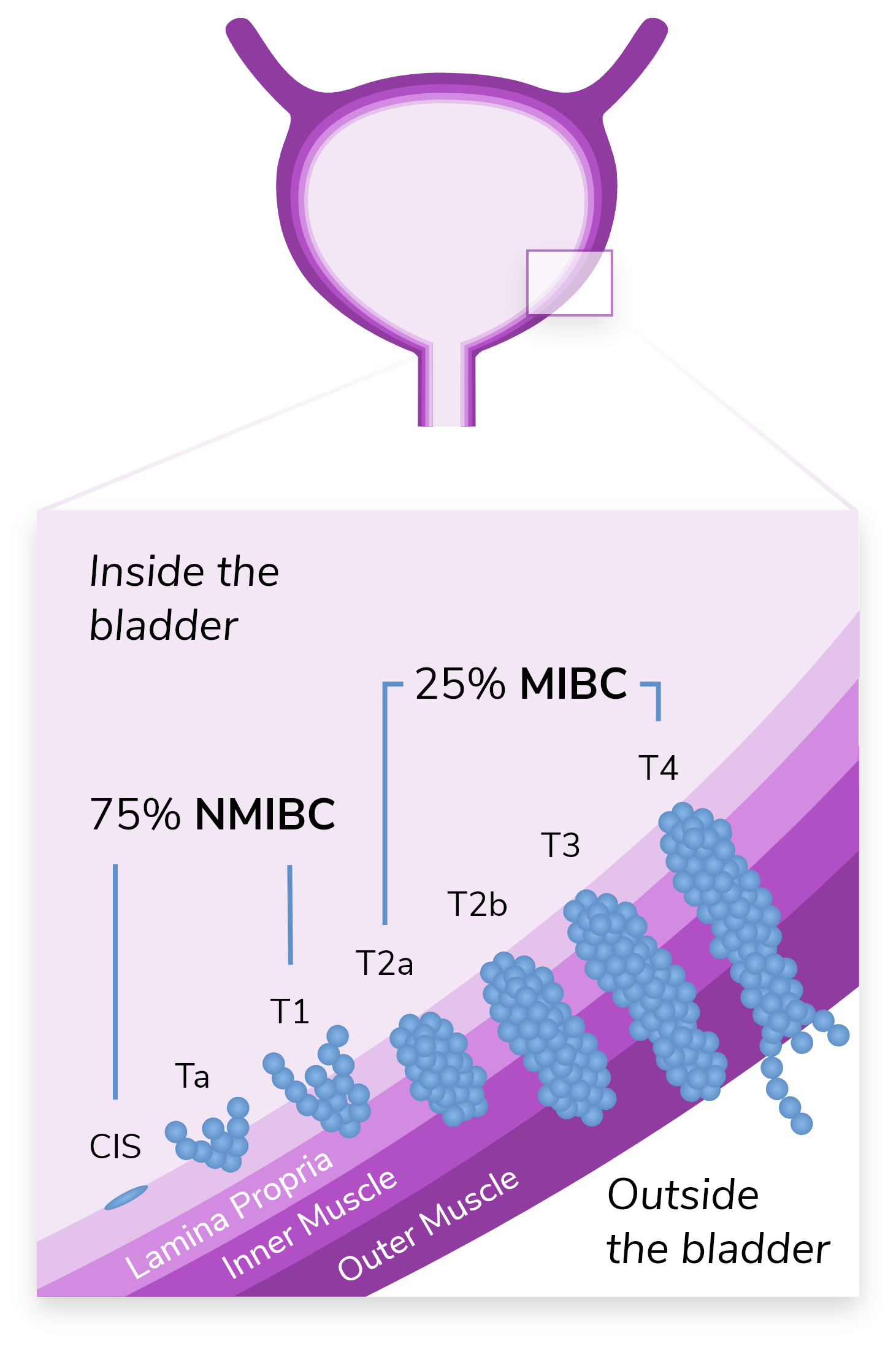 Inset image of a bladder, illustrating the stage at which bladder cancer patients are usually diagnosed