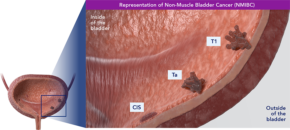 CG Oncology - NMIBC illustration - V2 - Labels graphic